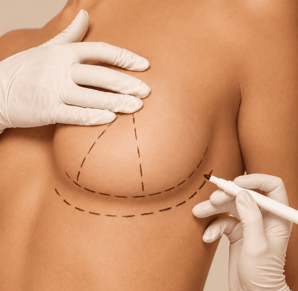 Breast Lift